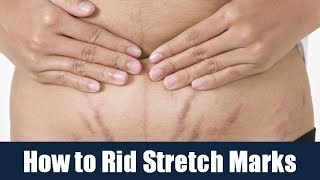 How to Rid Stretch Marks [upl. by Egiaf]