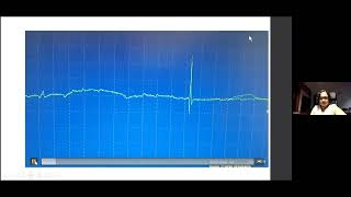 NERVE CONDUCTION STUDIES CRASH COURSE PART2 Dr Radhika Manohar [upl. by Pamela15]