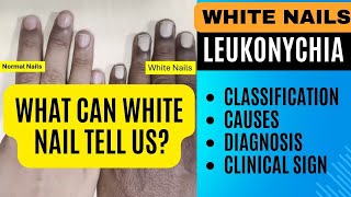 White Nails Leukonychia  Classification Causes Diagnosis  Nail Changes in Diseases [upl. by Warram]