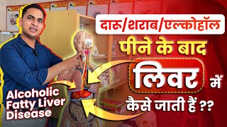 FullVideoदारूशराबएल्कोहॉल पीने के बाद वो लिवर में कैसे जाती हैं  Alcoholic Fatty Liver Disease [upl. by Pepi]