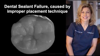 Dental Sealant Failure caused by improper placement technique [upl. by Aivatan]