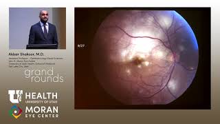 Uveitis Presentations [upl. by Barsky586]