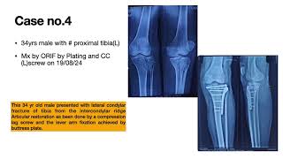 ORTHOPEDIC OPERATIONS PIMS AUGUST 2024 [upl. by Shutz]