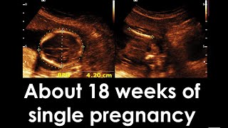 About 18 weeks 5 days 12 days of single viable pregnancy with breech presentation [upl. by Asoramla628]