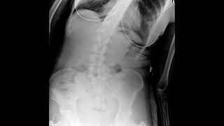 Lumbar XRay in Motion [upl. by Yelah643]