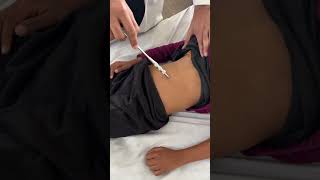 Abdominal reflex  superficial reflex  CNS examination  youtubeshortsviralvideomedicalstudent [upl. by Nidnal]