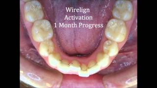 Wirelign® Orthodontics Invisible And Comfortable Way To Straighten Teeth [upl. by Poole]