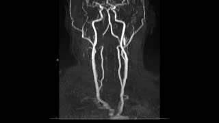 Noncontrast MRA magnetic resonance angiogram neck radiology search pattern [upl. by Myron98]