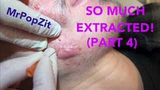 So much extracted Severe acne before and after Session 2 Comedones for days [upl. by Odlavso]