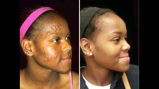 Acne Care for Black Skin  Before amp After Images [upl. by Duthie]