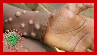 Monkeypox Overview and Symptoms MONKEYPOX CASES DETECTED IN US [upl. by Congdon805]