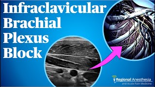 Infraclavicular Brachial Plexus Block [upl. by Sug207]