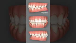 Overcrowding Crooked Teeth correction with Invisalign invisalignbeforeandafter makeovers [upl. by Harley]