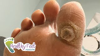 DEEP SATISFYING CALLUS TREATMENT [upl. by Ratcliffe31]