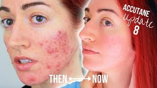 My Accutane Update 8 Months With Before amp After  Jess Bunty [upl. by Connors]