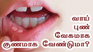 Mouth Ulcer Treatment at Home  Vaai Pun  Health Tips in Tamil [upl. by Ottinger]