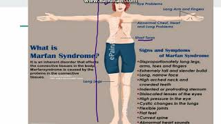 Marfan Syndrome [upl. by Leval]