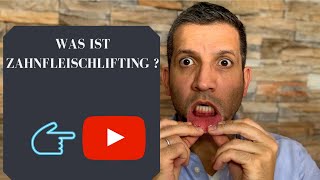 Was ist Zahnfleischlifting [upl. by Isnan]