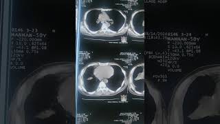 Decreased lung volume without any parenchymal abnormality [upl. by Wesa]