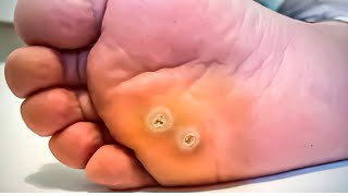 How To Remove a Foot Corn or Callus Foot Doctor Home Treatment [upl. by Filbert]