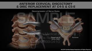 Dr Michael Halperin  2023 Artificial Cervical Disc Replacement Using A MobiC Implant [upl. by Ynattib]