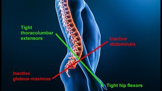 Lower Cross Syndrome  Eliminate Low BackHipKneeAnkle Pain [upl. by Adnert382]