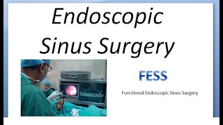 ENT FESS Functional Endoscopic Sinus Surgery Types Indications Uses [upl. by Nappy805]