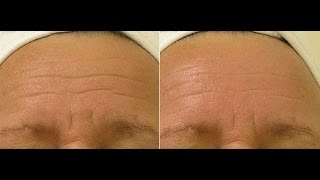 Hydra Facial Before amp After Gallery  Photos of Facial amp Body Skin Treatment in Princeton NJ [upl. by Kilroy]