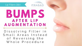 Bumps after Lip Augmentation  Dissolving Filler in a Small Focused Area [upl. by Bonner354]