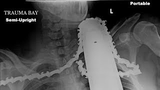 Horrific chainsaw accident Man gets blade stuck in neck and survives [upl. by Eppes202]