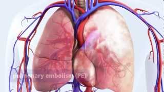 DVT can lead to pulmonary embolism PE [upl. by Aryhs]