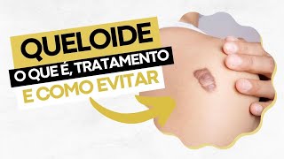 Queloide  o que é tratamento e como evitar [upl. by Eelidnarb]