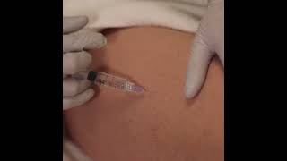 Mesotherapy  Injectables [upl. by Casandra]