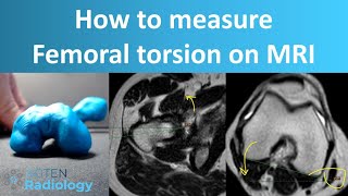 How to measure femoral torsion on MRI [upl. by Marcile]