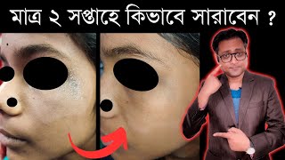 খুশকি থেকে মুখে সাদা দাগ  Seborrheic Dermatitis  Treatment  Bengali  Dr Supratim Saha [upl. by Harobed831]