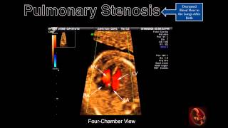 Fetal Echocardiography Pulmonary Stenosis [upl. by Imeon]