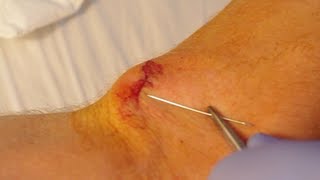 How To Give Yourself Stitches Sutures [upl. by Oiznun597]