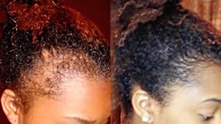 How to Regrow your Edges Bald Spots and Thinning Hair [upl. by Tomlinson]