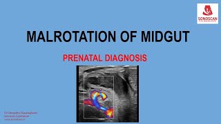 FETAL MALROTATION OF MIDGUT [upl. by Yentrac]