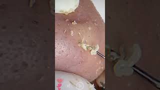 Skincare  Blackheads Removal 099 skincare skincare blackheads blackheads [upl. by Murial]