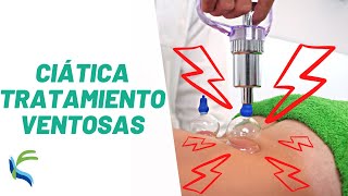 CIATICA tratamiento con VENTOSAS  Fisiolution [upl. by Hootman]