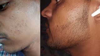 Minoxidil Beard Growth Journey  परमानेंट दाढ़ी कैसे उगाए [upl. by Aenneea572]