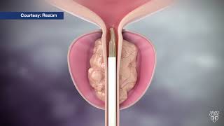 Mayo Clinic Minute Steam treatment for enlarged prostate [upl. by Annatnas]