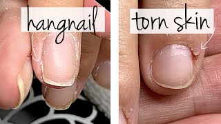 Hangnail or Torn Skin Do You Know the Difference [upl. by Ainimreh594]