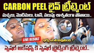 మొటిమలు శాశ్వతంగా పోయే టెక్నిక్  Carbon Peel Laser Treatment  Glowing Skin  Pimples Removal [upl. by Sucramrej]