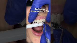 Cutting temporary smile 🪚🦷👀 veneers cutting temporarysmile asmr asmrmouthsounds veneerteeth [upl. by Champ]