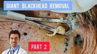 Massive blackhead removal inside a dermatology clinic  DrAMAZINGSKIN [upl. by Richter389]