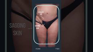 Tummy Tuck with Liposuction Surgery  Transformation [upl. by Refinnej]