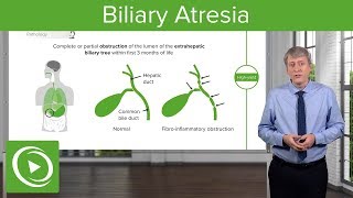 Biliary Atresia – Pediatrics  Lecturio [upl. by Nyloc349]