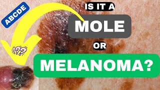 ABCDE of Melanoma Is it a Mole or Melanoma  ABCDE of Skin Cancer  Skin Cancer Symptoms and Signs [upl. by Jonell]